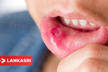 அடிக்கடி வாய்ப்புண் தொந்தரவு இருக்கா? இதனை எப்படி போக்கலாம்?