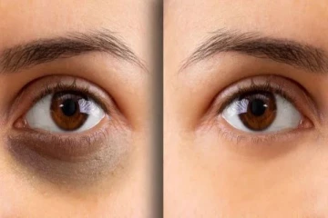 ஒரே வாரத்தில் கருவளையம் நிரந்தரமாக நீங்க உதவும் எளிய வீட்டு வைத்தியம்