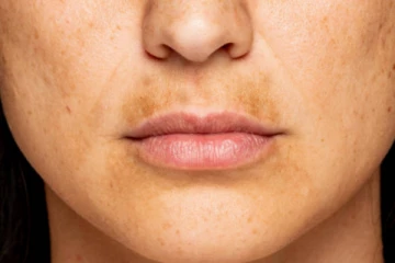 வீட்டிலேயே மேல் உதட்டின் கருமையை நீக்குவது எப்படி?