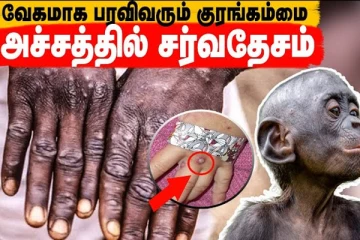 உலகநாடுகளே அச்சத்தில்...வேகமாக பரவிவரும் குரங்கம்மை!