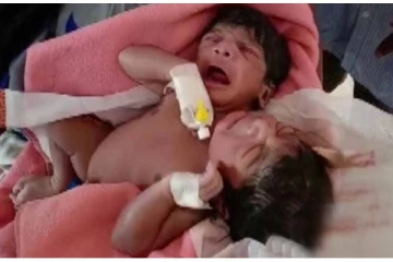 2 தலை, 3 கைகளுடன் ஒட்டிப் பிறந்த இரட்டை குழந்தைகள் - வைரல் போட்டோ!