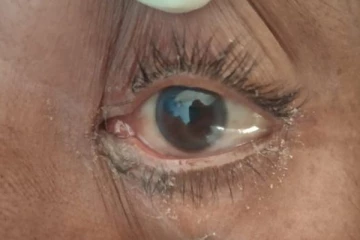 மூக்கில் இருந்து நீர் ஒழுகினால் அது கருப்பு பூஞ்சை நோய் தான்!