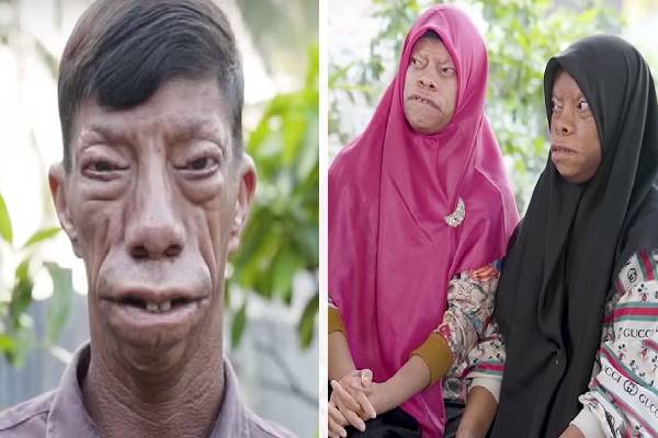 Lizard People: பல்லி முகம் கொண்ட அதிசய குடும்பம்! என்ன காரணம்? | Lizard People The Strange And Unique Disease