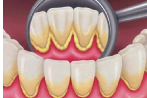 பற்களில் மஞ்சள் கறையை உண்டாக்கி அரிப்பை ஏற்படுத்தும் உணவுகள்...இனி எச்சரிக்கையா இருங்க? | Foods And Drinks That Can Stain Your Teeth