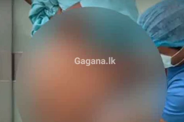 ලෝක වාර්තාවක් තබමින් තෙල් ලීටර් 13.5ක් ඉවත් කළ මෙරට විස්මිත සැත්කම