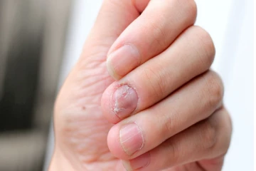 நகச்சுற்றி வந்தால் எப்படி குணப்படுத்துவது?  கட்டாயம் தெரிந்து கொள்ளுங்கள்!