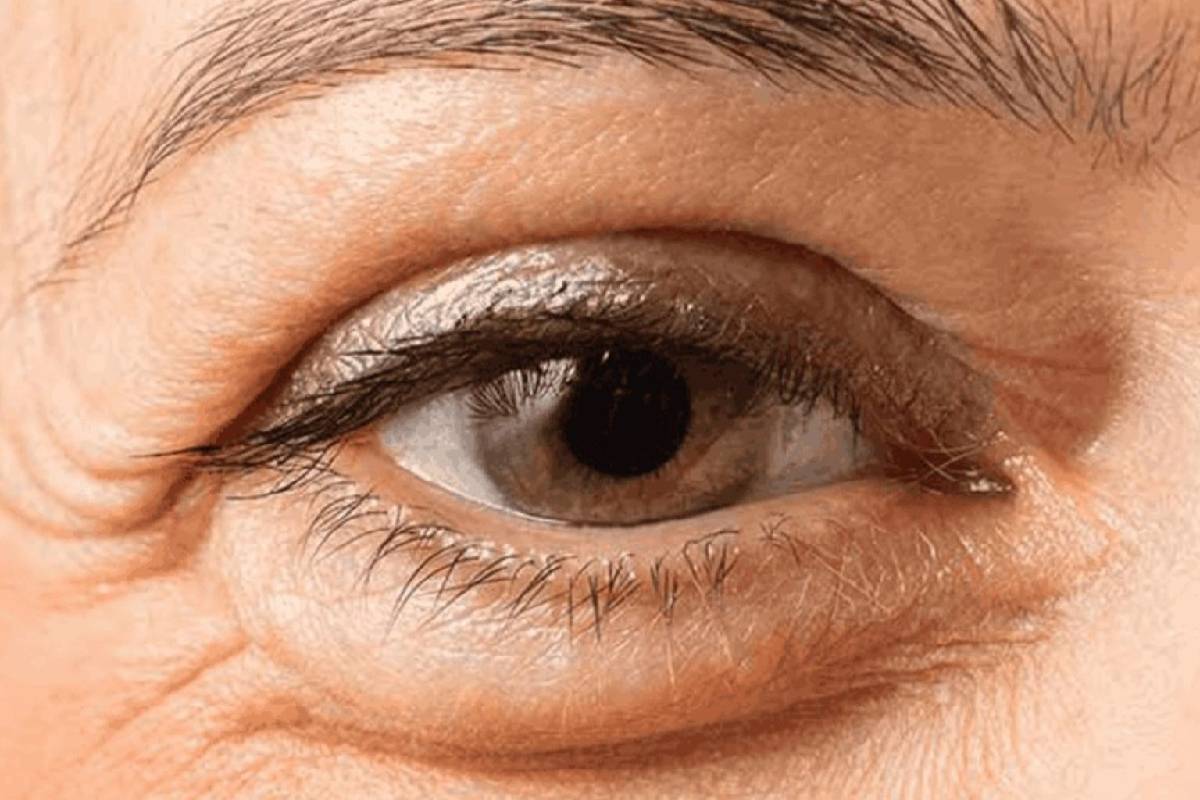 காலையில் எழுந்ததும் கண்களில் நீர் வடியுதா? இந்த நோய் தான் காரணம் | This Disease Causes Watery Eyes In The Morning