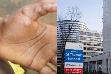 பிரித்தானியாவை குறிவைத்த Monkeypox: எச்சரிக்கை விடுத்த சுகாதாரத்துறை