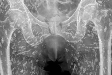 உணவில் செய்த ஒரு தவறு... பாதி உடலில் புழுக்களுடன் மருத்துவமனைக்கு வந்த நபர்