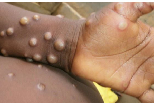 மக்களே உஷார்!! ஓரினச்சேர்க்கையாளர்களிடம் அதிகளவில் பரவும் குரங்கு அம்மை - வெளியான அதிர்ச்சி தகவல்! | High Number Of Homeosexuals Affected By Monkey Pox