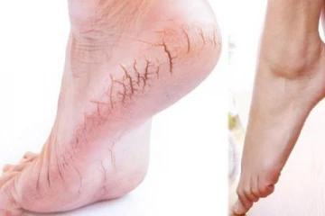 காலில் பித்தவெடிப்பா? கவலையை விடுங்க!