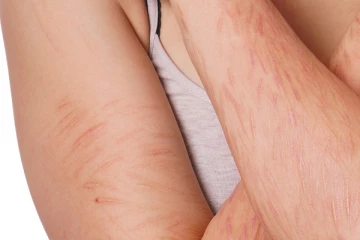 உடலில் ஏற்பட்ட தழும்பை மறைய வைக்க வேண்டுமா? இதோ சில அசத்தலான டிப்ஸ்!