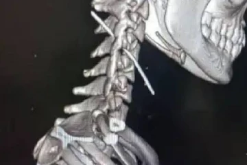 தையல் ஊசி மூலம் விபரீத தற்கொலை முயற்சி - கோவை பெண்ணின் உயிரைக் காப்பாற்றிய அரசு மருத்துவர்கள்