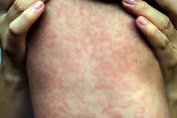 அமெரிக்காவில் தட்டம்மை நோயாளர்களின் எண்ணிக்கையில் திடீர் உயர்வு