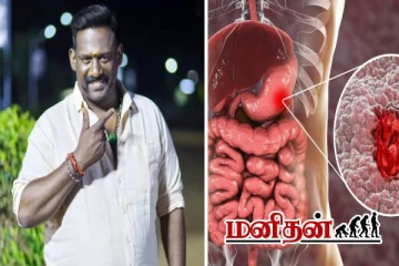 ரோபோ சங்கர் உயிரை காவு வாங்கிய நோய்.. அறிகுறிகளும், பாதிப்புகளும்