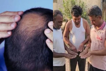 முடி கொட்டியதை தொடர்ந்து நகங்கள் உதிர்வதால் பீதியில் ஆழ்ந்துள்ள கிராம மக்கள்