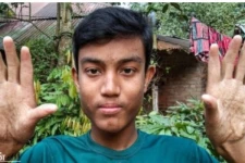 மூன்று தலைமுறைகளாக கைரேகையே இல்லாத ஆண்கள்! வினோத நோயால் அவதி