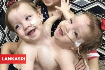 வயிறும் மார்பும் இணைந்து ஒட்டிப்பிறந்த இரட்டைக் குழந்தைகள்... இப்போது எப்படி இருக்கிறார்கள் பாருங்கள்