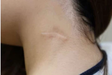 எவ்ளோ பெரிய தழும்பா இருந்தாலும் மறைக்கும் சக்தி இந்த ஒரே ஒரு பொருளுக்கு உண்டு....!