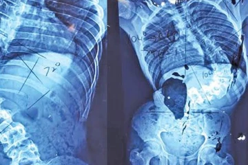 பதுளையில் நடத்தப்பட்ட அபூர்வ சத்திர சிகிச்சை