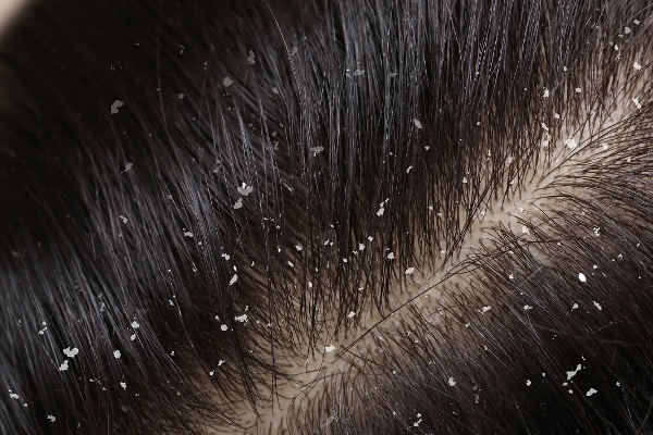 பொடுகு தொல்லையில் இருந்து நிரந்தர தீர்வு வேண்டுமா? இந்த ஒரே ஒரு துளி சாறு போதும்... | Benefits Of Potato Juice For Hair