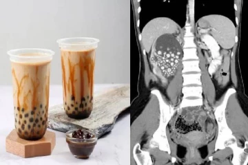 பபிள் டீ குடித்த பெண்: சிறுநீரகத்தில் இருந்து 300 கற்களை அகற்றிய மருத்துவர்கள்