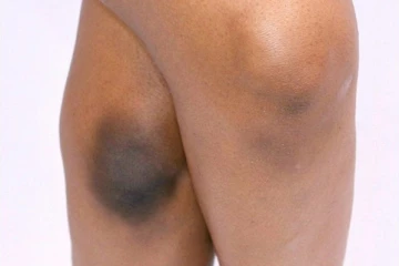 உங்க முட்டி கருப்பாக இருக்கா? அதனை போக்க இதோ சூப்பர் டிப்ஸ்!