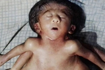 4 கால்கள், 4 கைகள், 4 காதுகளுடன் ஒட்டிப் பிறந்த குழந்தை - ஷாக்கான மருத்துவர்கள்