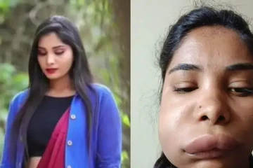 பல் வலியால் ஹாஸ்பிடலுக்கு சென்ற நடிகை! முகம் கோரமாக மாறியதால் அதிர்ச்சி