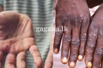 මන්කිපොක්ස් ගැන සෞඛ්‍ය අංශ වෙතින් ජනතාවට විශේෂ දැනුම්දීමක්.