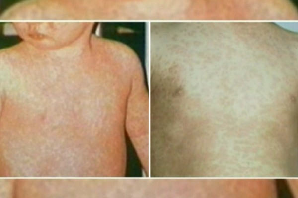 கல்கரியில் பரவி வரும் நோய்த் தொற்று | Alberta Health Services Issues Measles
