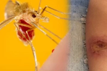 නව රෝගයක් යළි හිස ඔසවයි - මේ සම්බන්ධයෙන් සැලකිලිමත් වන්න..