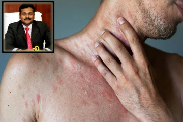 வெயில் காலத்தில் தோலில் வரும் அக்கி நோய் - டாக்டர் கார்த்திகேயன் விளக்கம்