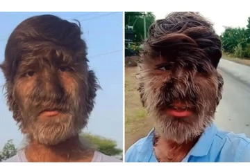 குரங்குபோல் உடல் முழுவதும் அடர்ந்த ரோமங்கள்...அரிய வகை நோயால் பாதிக்கப்பட்ட சிறுவன்...! வைரலாகும் வீடியோ