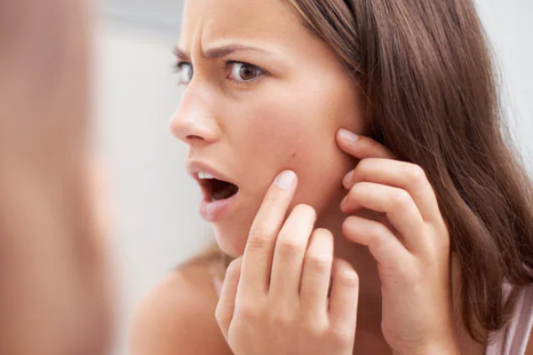 முகப்பருக்களால் கவலையா! தடுக்க  மிக மிக எளிய வழி | Worried About Acne A Very Very Simple Way