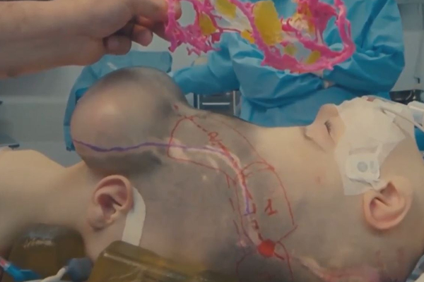 விடிய விடிய நடந்த அறுவை சிகிச்சை! ஒட்டி பிறந்த தலையை பிரித்த மருத்துவர்கள் | Piresil Docter