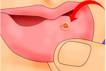 வாய்ப்புண்ணால எதுவுமே சாப்பிட முடியலையா? இதை குழைத்து போடுங்க