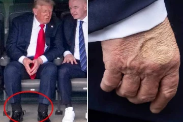 கணுக்காலில் வீக்கம்.. இதயத்துக்கு ரத்தம் செல்வதில் பாதிப்பு - டிரம்ப் ஷாக் தகவல்