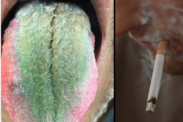 நாக்கில் கொத்தாக வளரும் முடி; சிகரெட்டால் இப்படி ஒரு பிரச்சனையா? ஷாக் சம்பவம்!