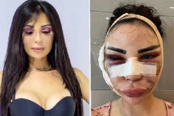 4 கோடியில் 40 அறுவை சிகிச்சை செய்த அழகிக்கு நேர்ந்த விபரீதம்!