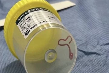 பெண் ஒருவரின் மூளையில் இருந்து உயிருடன் கண்டெடுக்கப்பட்ட புழு!