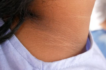 கழுத்தில் உள்ள கருமை நீங்க இத செய்ங்க போதும்