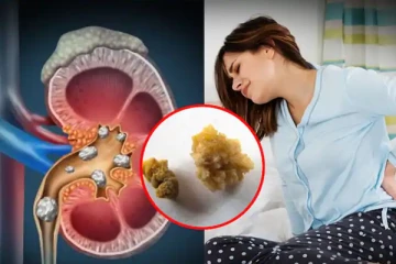 சிறுநீரக கல் பிரச்சினையால் அவதியா? இதனை கரைக்க இதோ சில எளிய வழிகள்