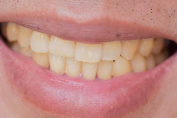 உங்கள் பற்கள் மஞ்சளாக உள்ளதா? இதனை போக்க சூப்பர் டிப்ஸ் இதோ! | Home Remedies For Yellow Teeth