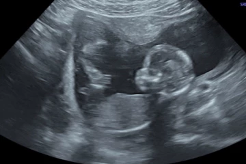 20 ஆண்டுகளுக்கு பின் உருவான கரு! 5 மாதத்தில் மருத்துவர்களுக்கு காத்திருந்த அதிர்ச்சி....பிறகு நடந்த அதிசயம்