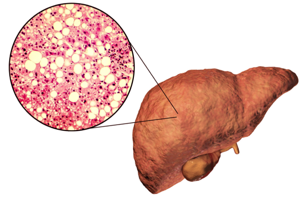 நடிகர் அபினய்க்கு வந்த கல்லீரல் நோய் - விளக்கிய மருத்துவர் | Doctorfarook Abdulla Explain Abhinay Liver Disease