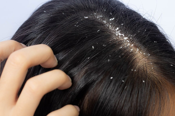 பொடுகு தொல்லைக்கு முற்றுப்புள்ளி வேண்டுமா? இதோ அசத்தலான டிப்ஸ் | Want An End To Dandruff