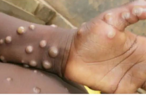 இந்தியாவுக்குள் நுழைந்ததா குரங்கு அம்மை? - அரசு வெளியிட்ட அதிர்ச்சி தகவல்! | Ghaziabad Child Sample Sent To Pune Lab Monkey Pox