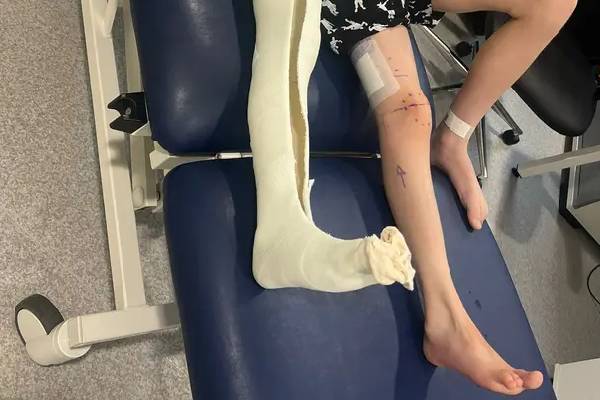 அறுவை சிகிச்சையால் தனது காலின் நீளத்தை அதிகரித்து சாதனைப் படைத்த சிறுவன் | Boy Increasing The Length Of His Leg Surgery