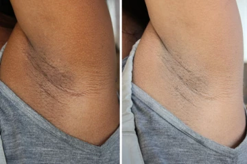 அக்குள் கருப்பா அசிங்கமா இருக்கா? ஒரே இரவில் வெள்ளையாக்க இந்த ஒரு பொருள் போதும்!